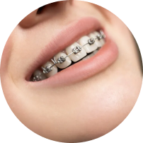 Standard Metal Braces