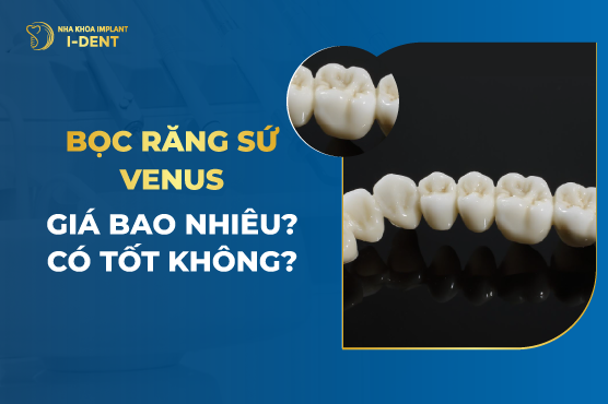Răng Sứ Venus Có Đặc Điểm Gì? Có Tốt Không? Bảng Giá