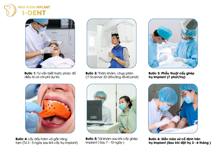 cấy ghép implant all on 4