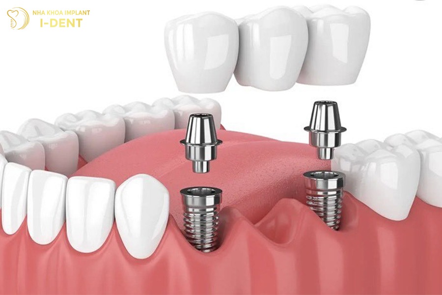 cắm implant