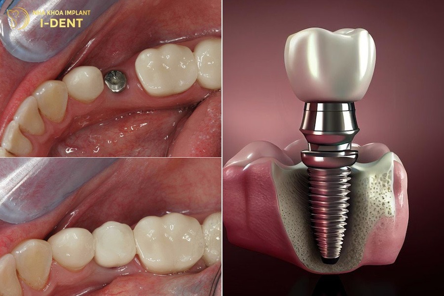 cấy implant