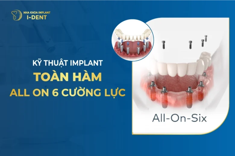 Kỹ Thuật Implant Toàn Hàm All On 6 Cường Lực Cao Cấp