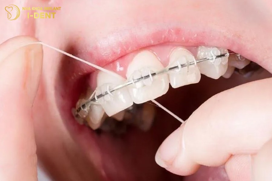 răng sâu niềng được không