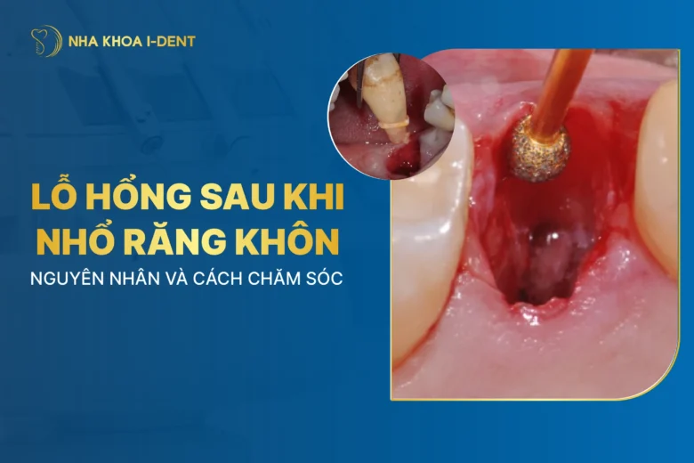 Lỗ Hổng Sau Khi Nhổ Răng Khôn: Nguyên Nhân Và Cách Chăm Sóc