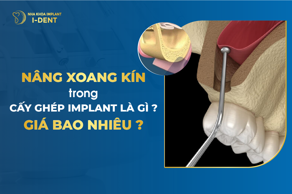 Nang Xoang Kin Trong Cay Ghep Implant La Gi Gia Bao Nhieu