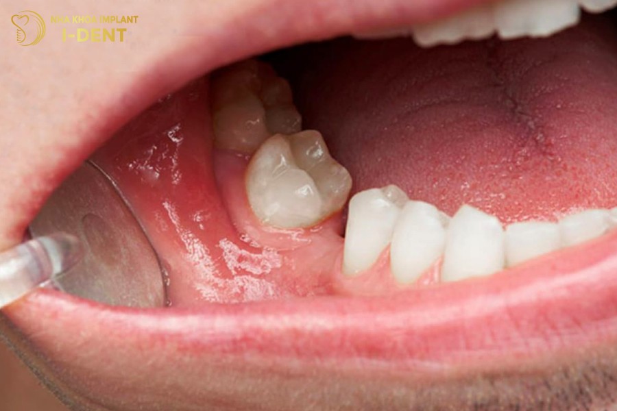 Nho-rang-so-6-gay-xo-lech-cac-rang-ke-can