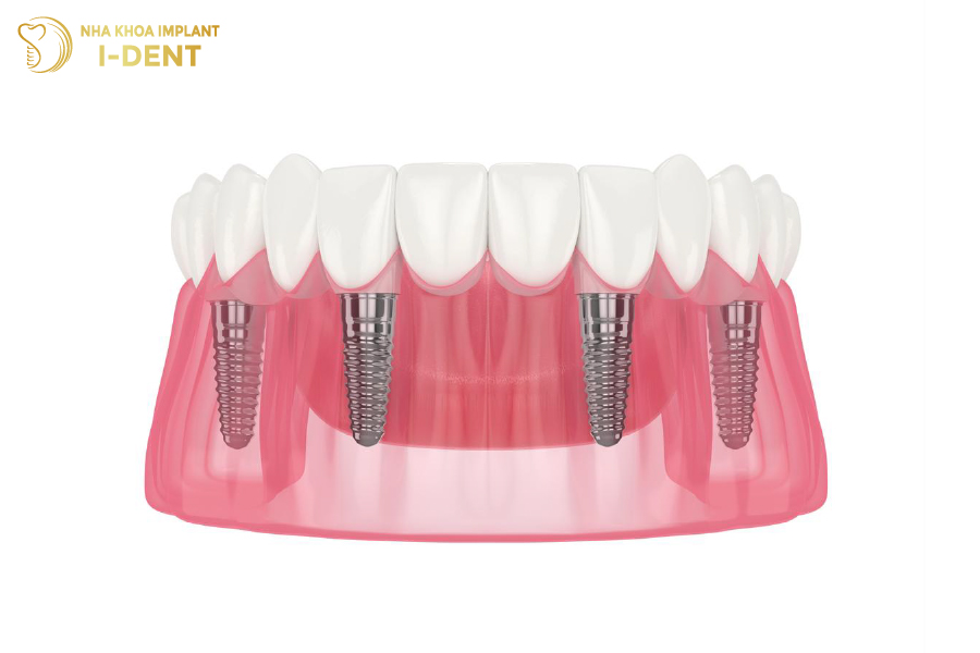 cấy ghép implant all on 4