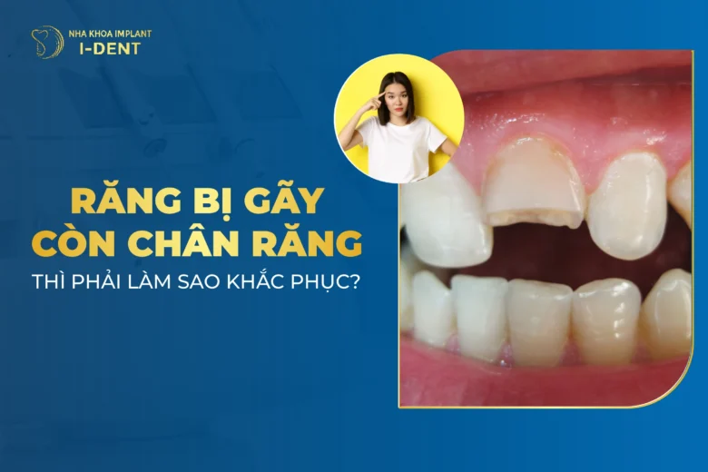 Răng Gãy Còn Chân: Nguyên Nhân, Tác Hại Và Cách Xử Lý