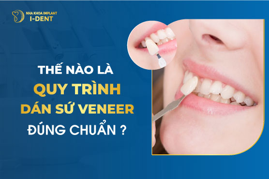 Thế Nào Là Quy Trình Dán Răng Sứ Veneer Đúng Chuẩn?
