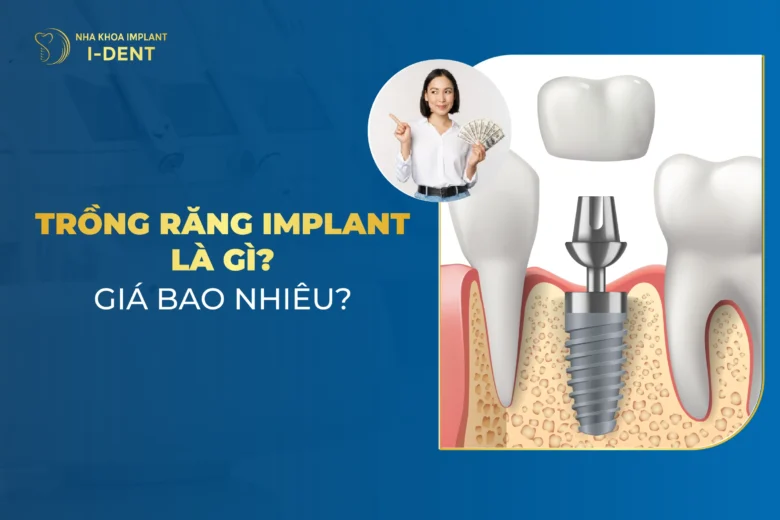 Trồng răng Implant: Giá, Ưu điểm, Quy trình và Địa chỉ cấy răng