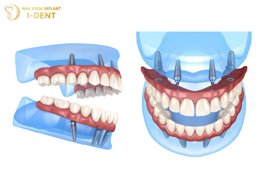 implant all on 4 là gì
