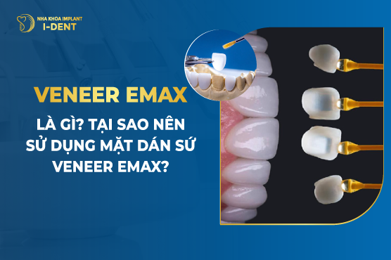 Veneer Emax Là Gì? Tại Sao Nên Sử Dụng Mặt Dán Sứ Veneer Emax?