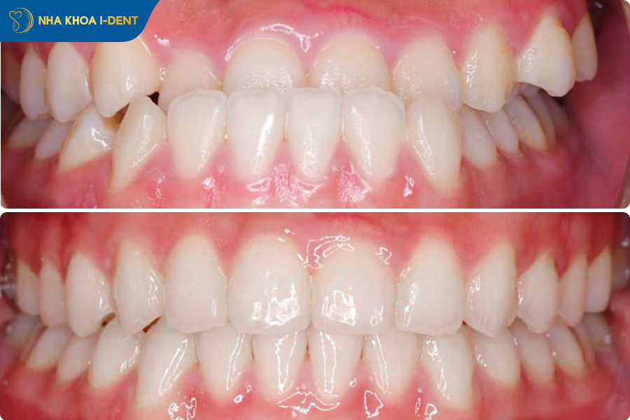 ảnh niềng răng