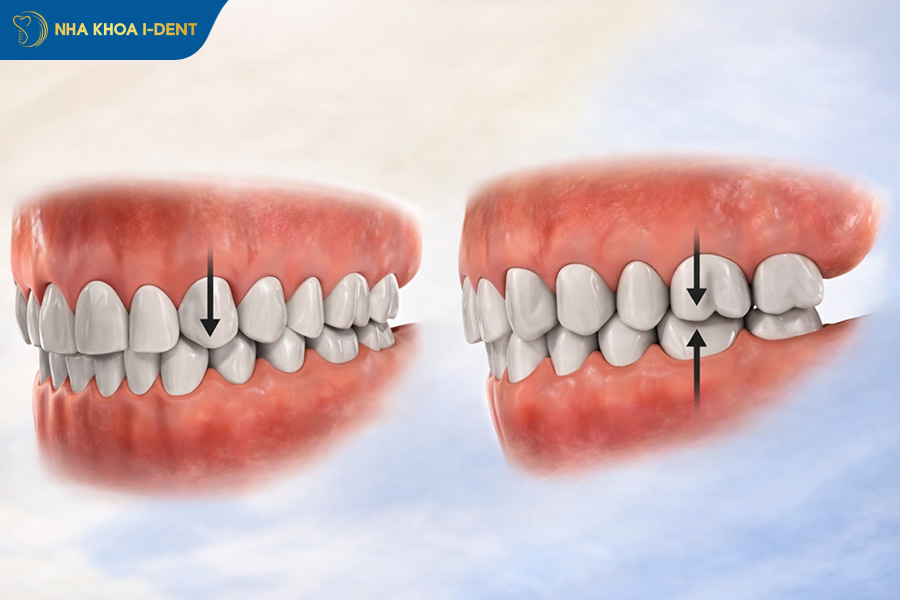 bị lệch khớp cắn