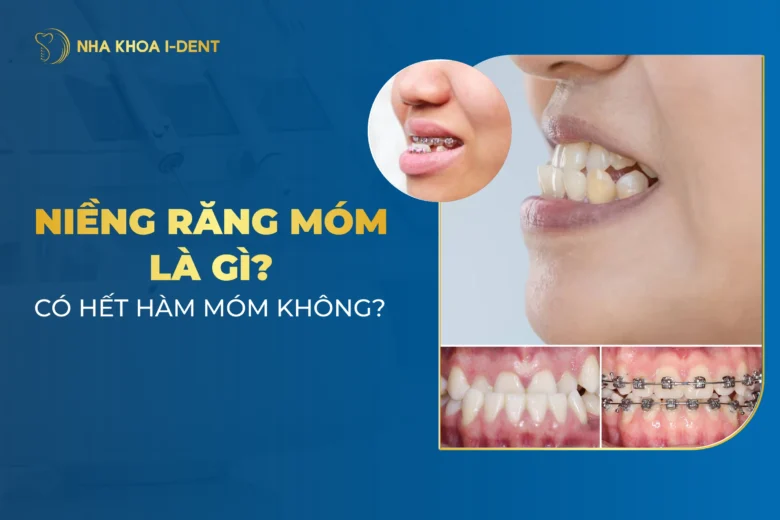 Niềng Răng Có Hết Móm Không? Bị Móm Có Nên Niềng?