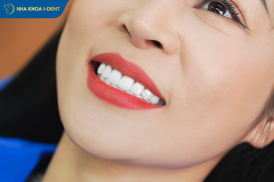 bọc răng sứ cho 4 răng cửa bị hô có được không