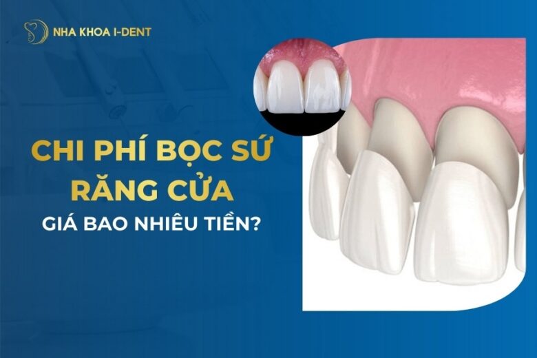 Chi Phí Bọc Răng Sứ 2 Răng Cửa Giá Bao Nhiêu Tiền?