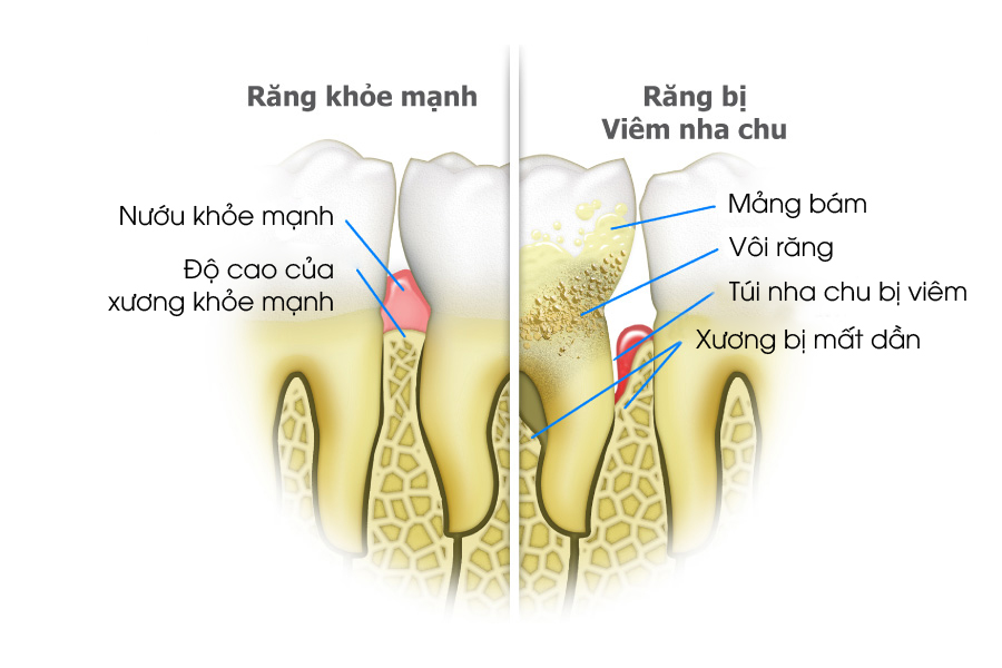 nhổ răng cấm không trồng lại có sao không