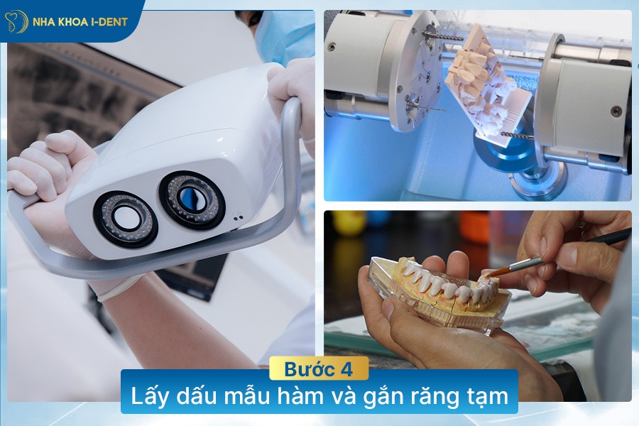 các bước trồng răng implant