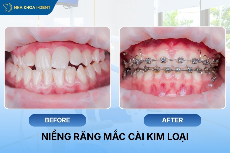 các loại niềng răng và chi phí
