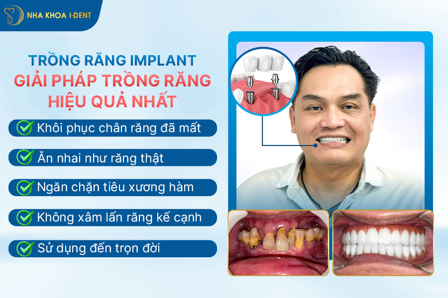 các loại trồng răng