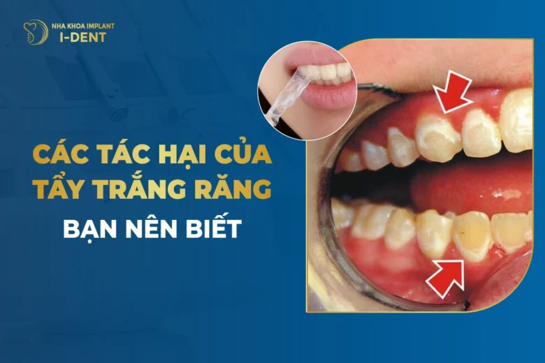 6 Tác Hại Của Tẩy Trắng Răng Cần Biết Trước Khi Quyết Định Làm