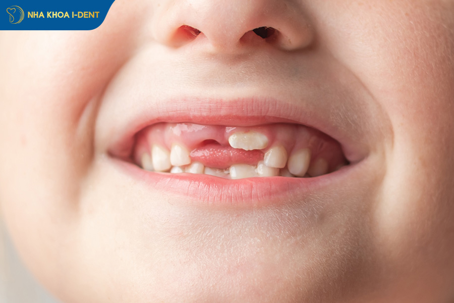 cách nhổ răng không đau tại nhà