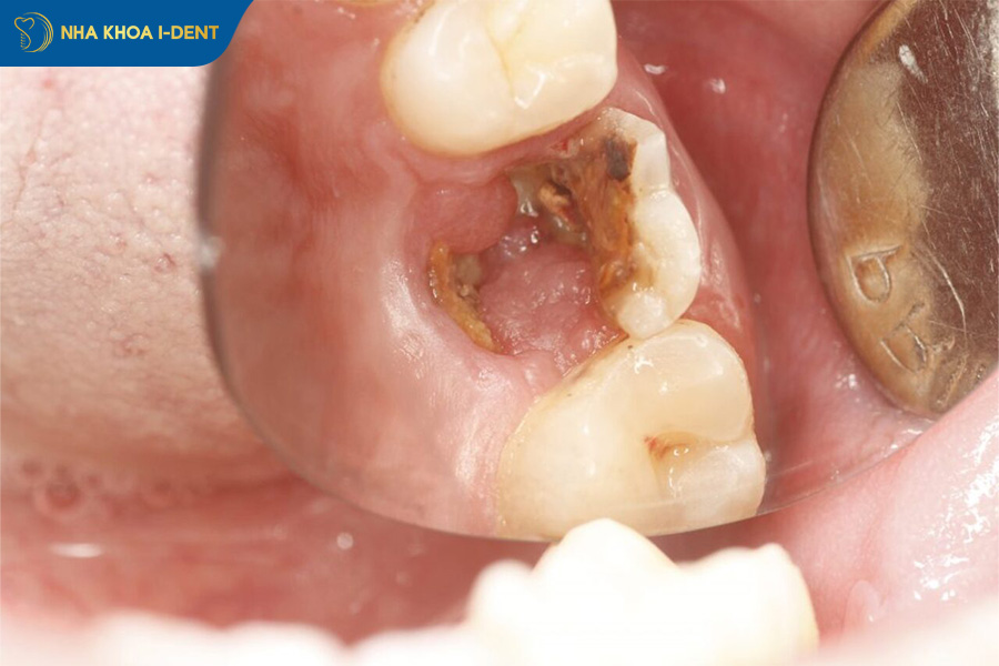 có nên làm răng sứ không