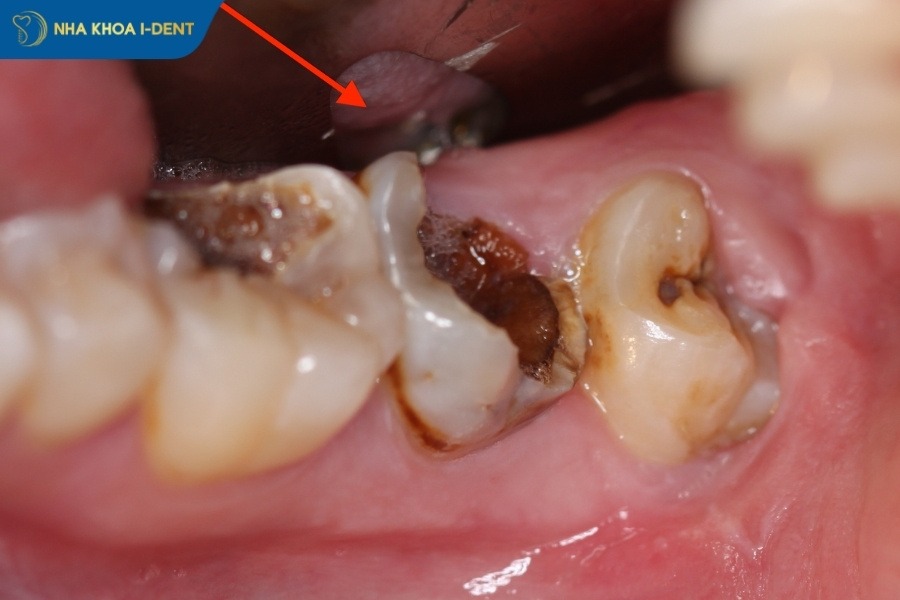 có nên nhổ răng sâu không