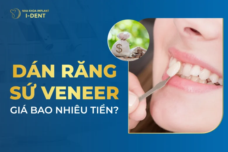 Dán Răng Sứ Veneer Giá Bao Nhiêu Tiền? Bảng Giá 2026