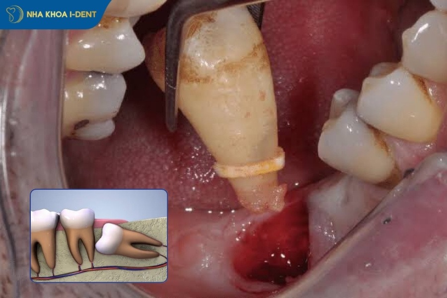 giá nhổ răng khôn