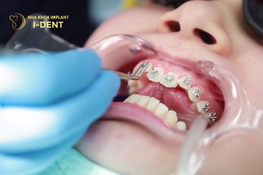 niềng răng cho trẻ 12 tuổi