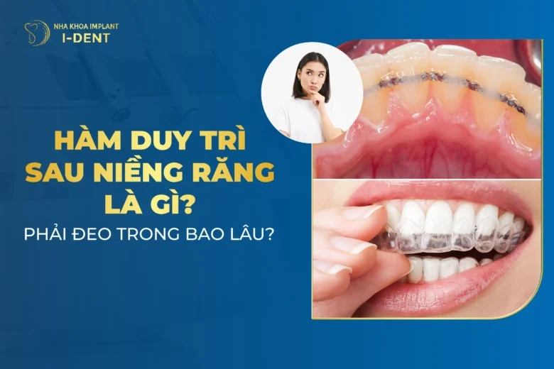 Hàm Duy Trì Sau Niềng Răng Có Mấy Loại? Đeo Trong Bao Lâu?