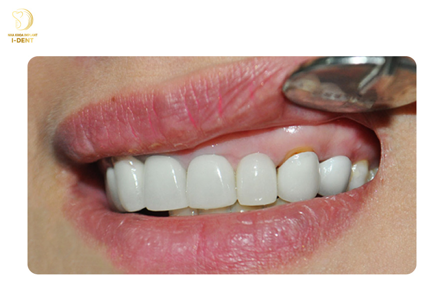 bọc răng sứ có ảnh hưởng gì không