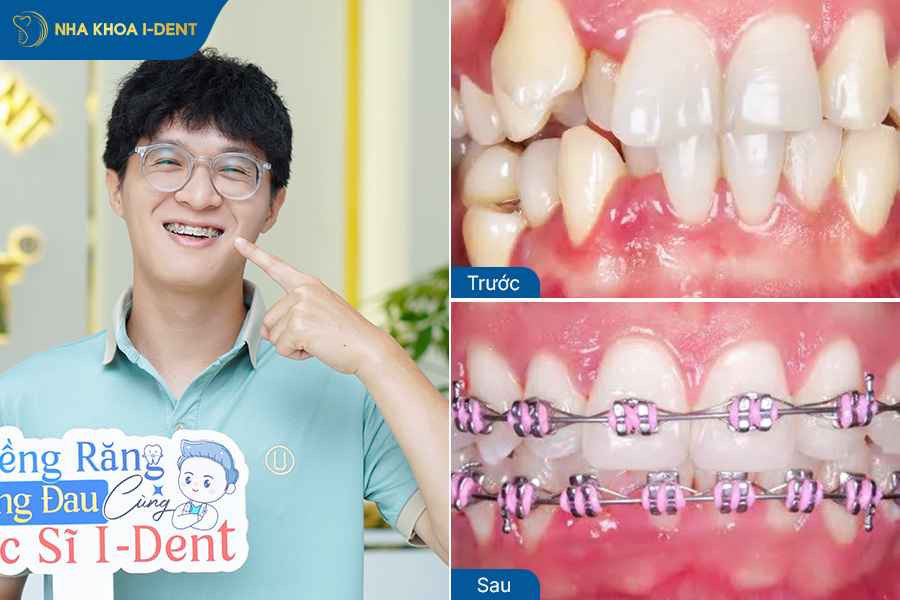 Hình ảnh sau khi niềng răng móm