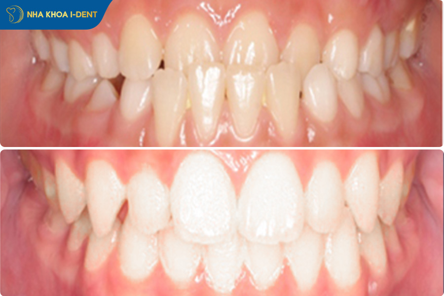 hình ảnh niềng răng