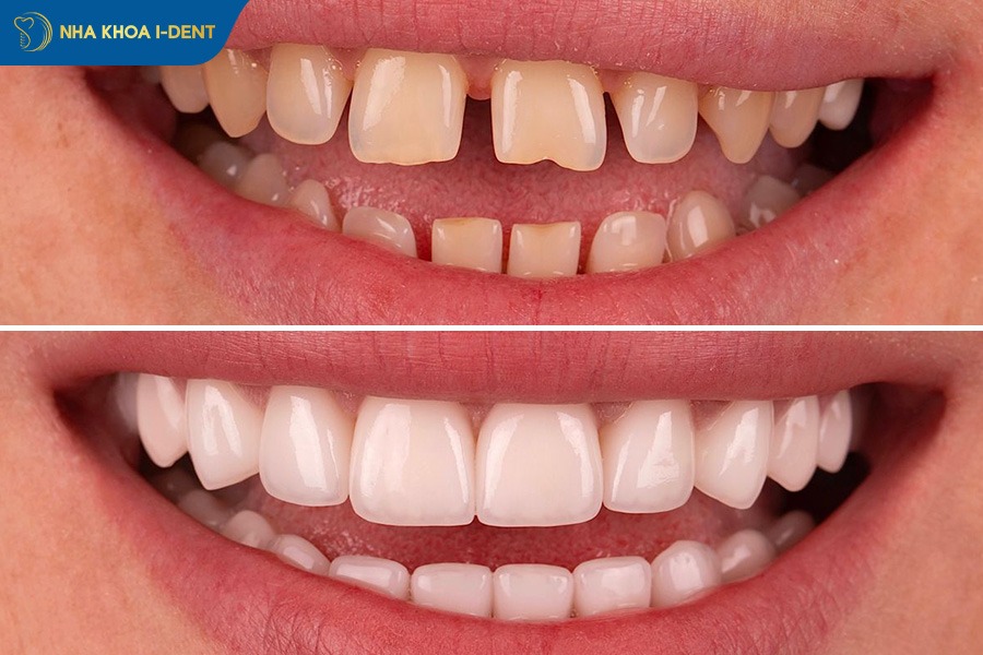 hình ảnh răng sau khi mài