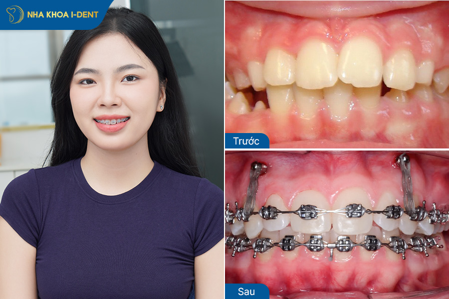 Hình ảnh sau khi niềng răng hô