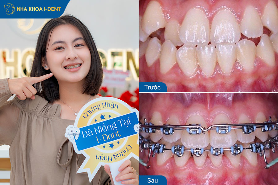 Hình ảnh sau khi niềng răng lệch lạc