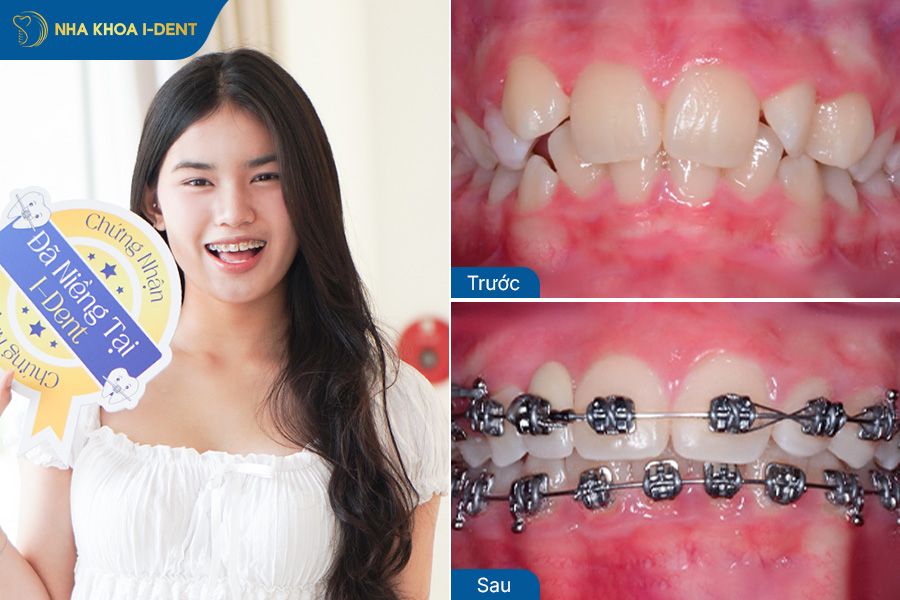 Hình ảnh sau khi niềng răng lệch lạc