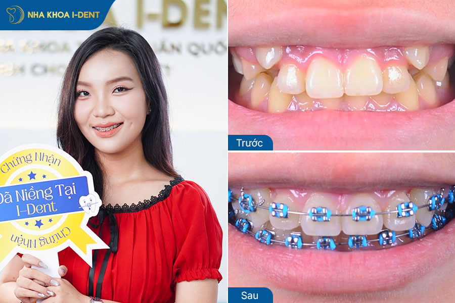 Hình ảnh sau khi niềng răng lệch lạc