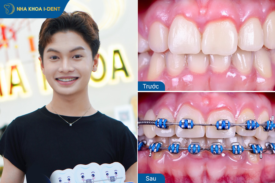 Hình ảnh sau khi niềng răng móm
