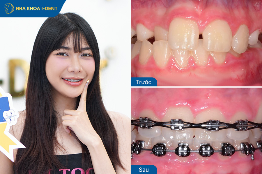 Hình ảnh sau khi niềng răng thưa