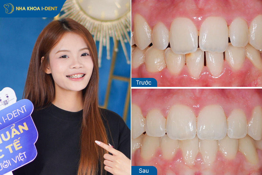 Hình ảnh sau khi niềng răng thưa
