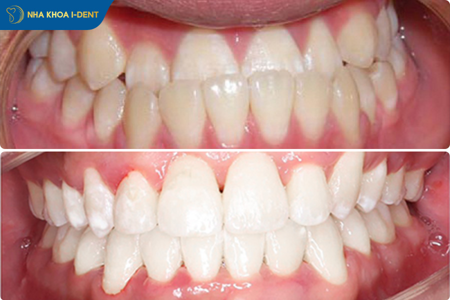 hình ảnh trước và sau khi niềng răng