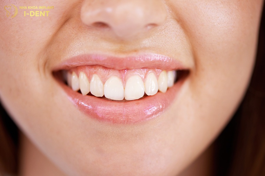 hô lợi có niềng răng được không