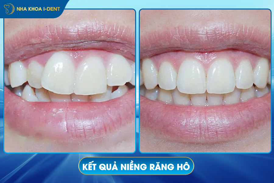 kết quả niềng răng hô