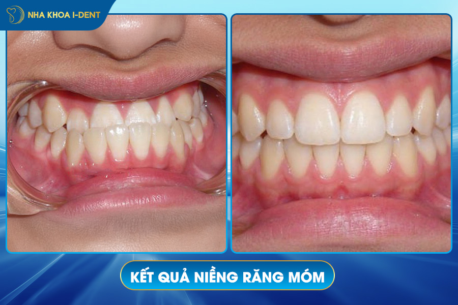 kết quả niềng răng móm