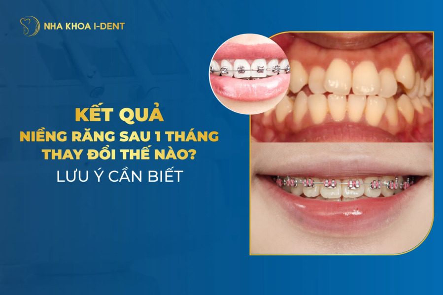 kết quả niềng răng sau 1 tháng