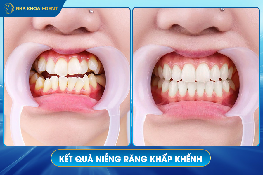 kết quả niềng răng sau 1 tháng